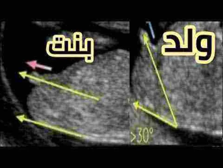 الفرق بين حمل الولد والبنت في الشهور الأولى