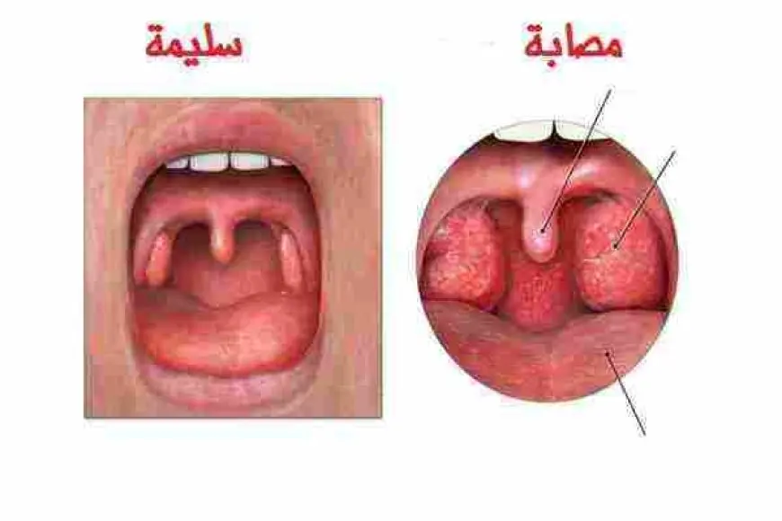 علاج احتقان الحلق للأطفال بدون مضاد حيوي