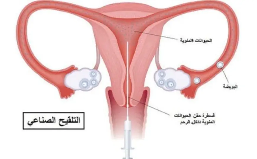 خطوات التلقيح الصناعي بالصور